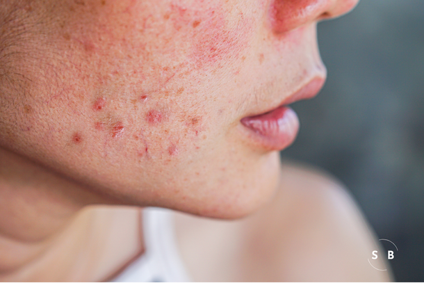 The Ultimate Guide to Acne: Causes, Treatments, and Prevention