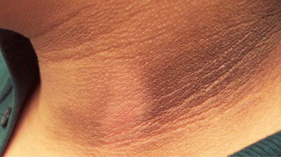 Acanthosis Nigricans