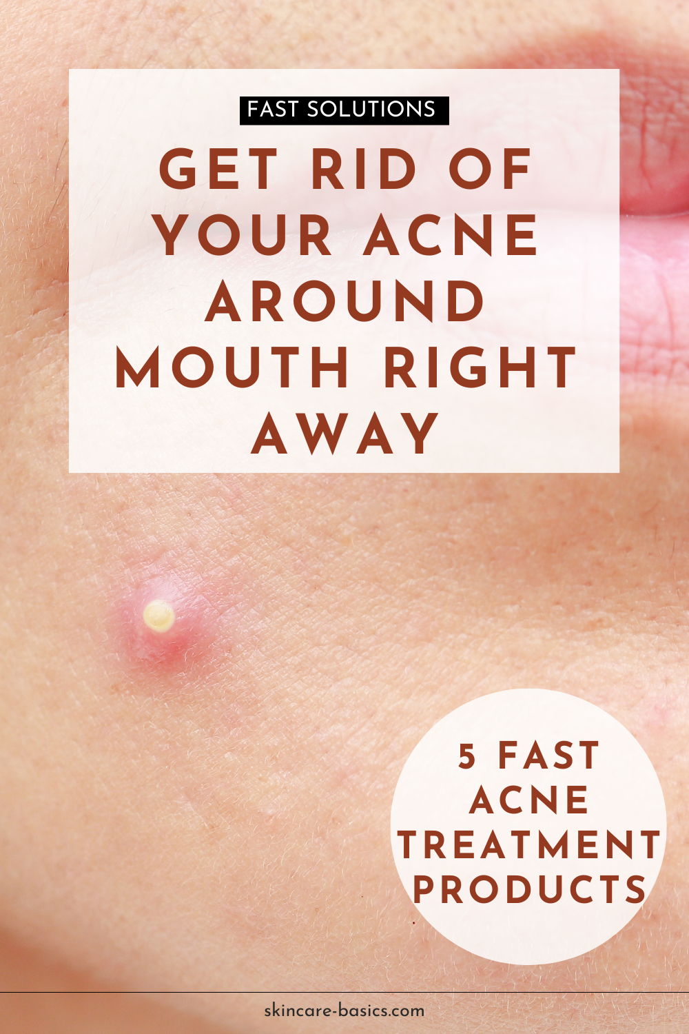 How to Get Rid of Acne Around Mouth?