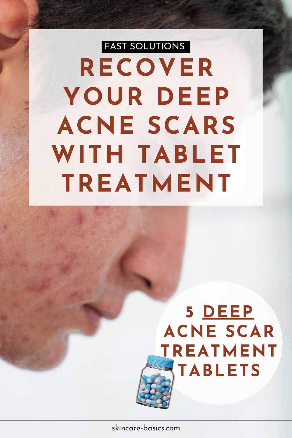 How to Recover Your Deep Acne Scars with Tablets