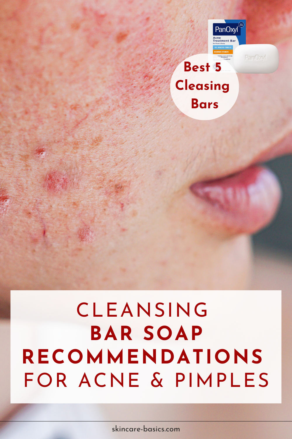 How to Treat Your Acne with Cleansing Bar?