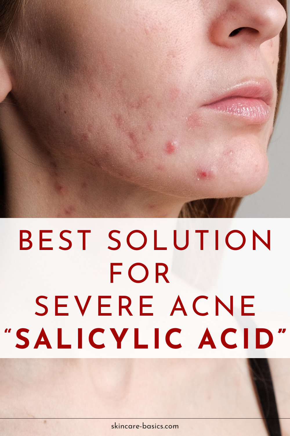 Best Solution for Severe Acne is Salicylic Acid