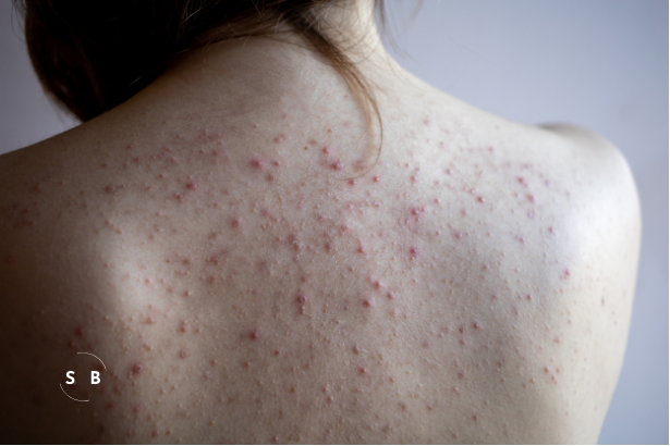 Managing Body Acne: Backne, Buttne, and More