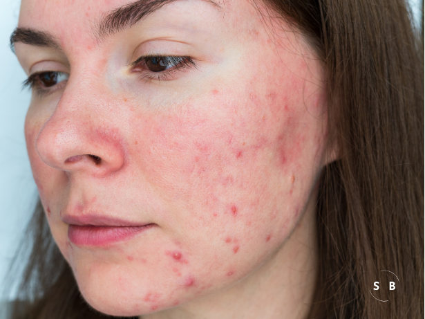 7 Essential Tips for Managing Sensitive Skin