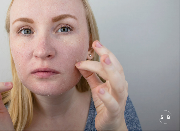 Understanding the Root Causes of Dry Skin: A Comprehensive Guide