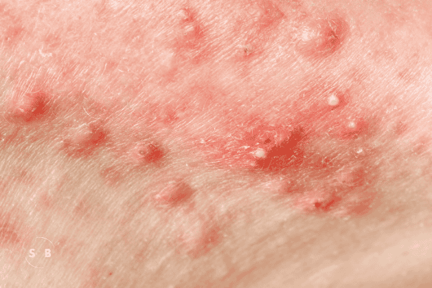 Understanding Cystic Acne: Causes, Treatments, and Tips