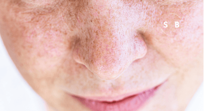 How to Treat Hyperpigmentation